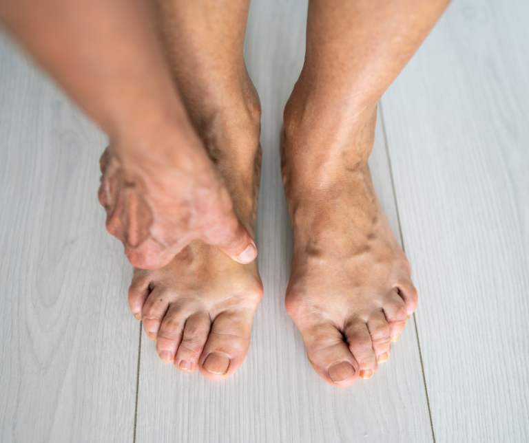 How to Handle Bunions at Home (With Our Help!)