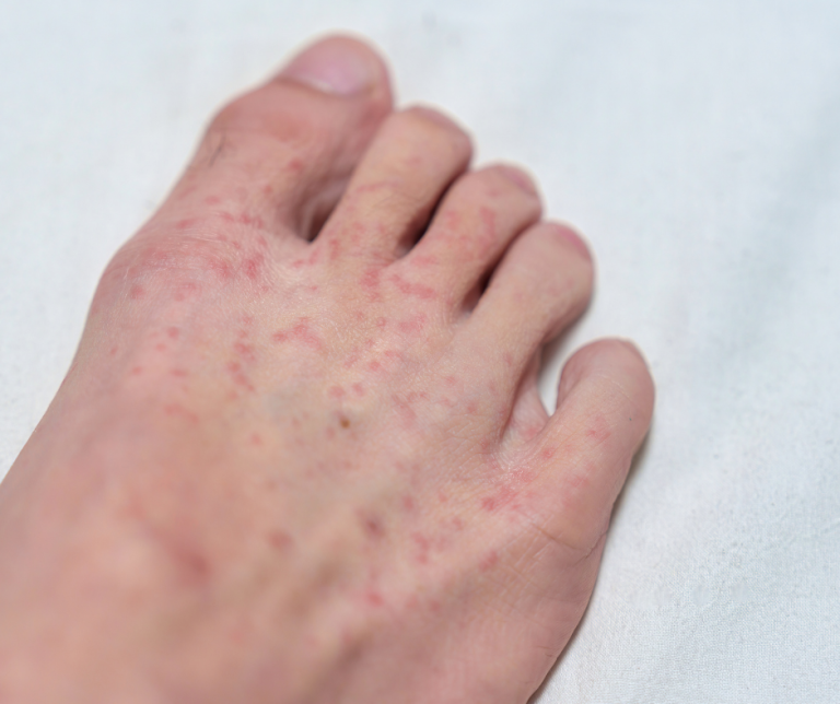 What Is That Red Spot on Your Foot? 