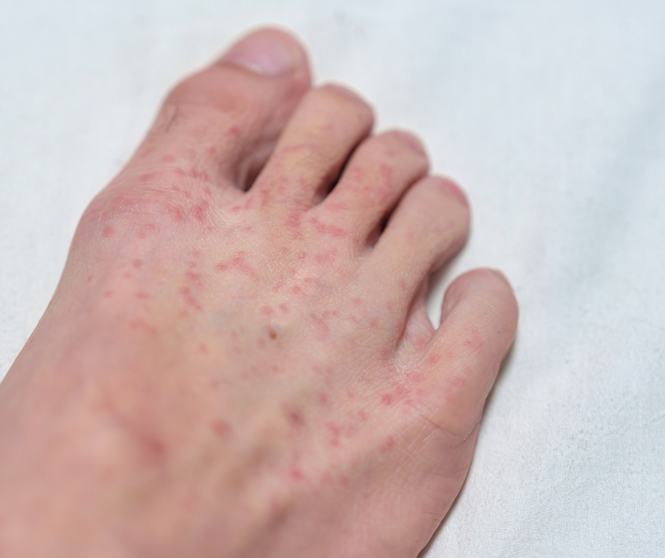 foot with red spots