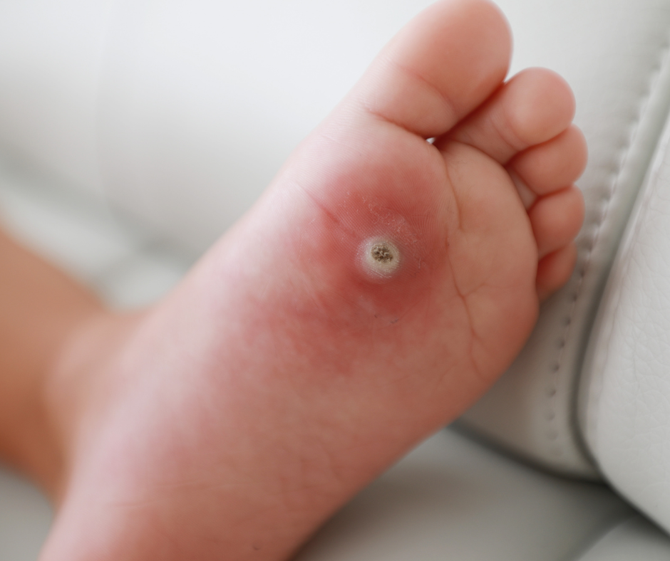 plantar wart on foot